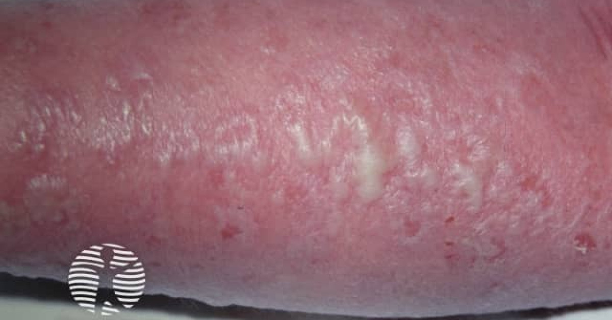 DermNet® - Staphylococcal scalded skin syndrome image