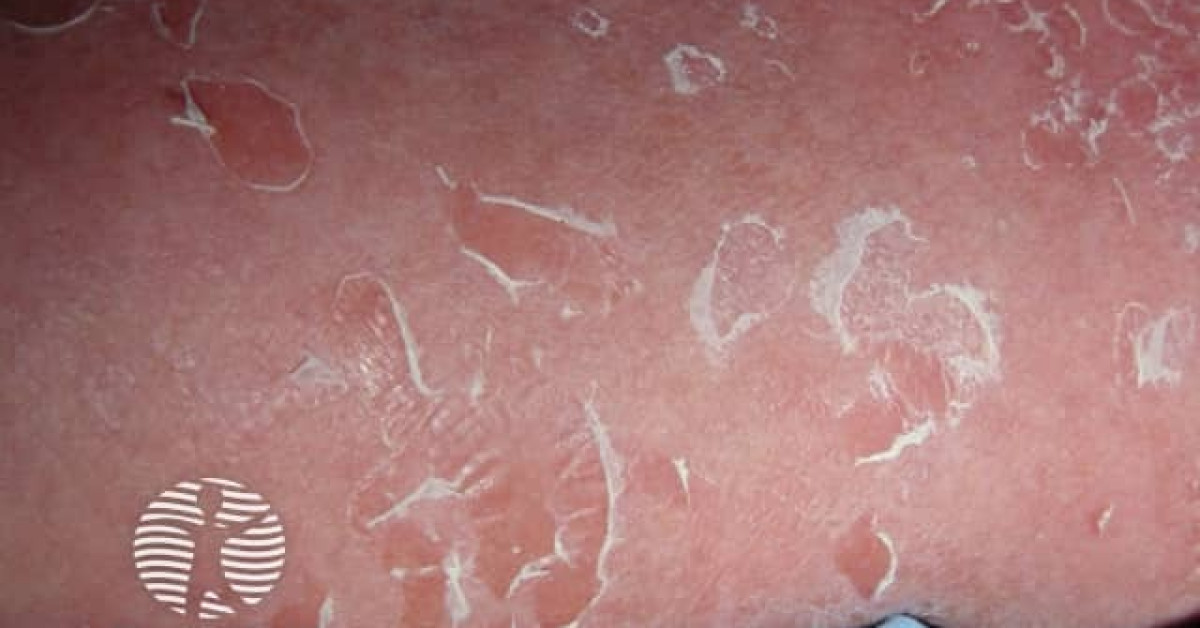 Staphylococcal scalded skin syndrome image