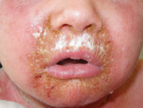 Staphylococcal scalded skin syndrome