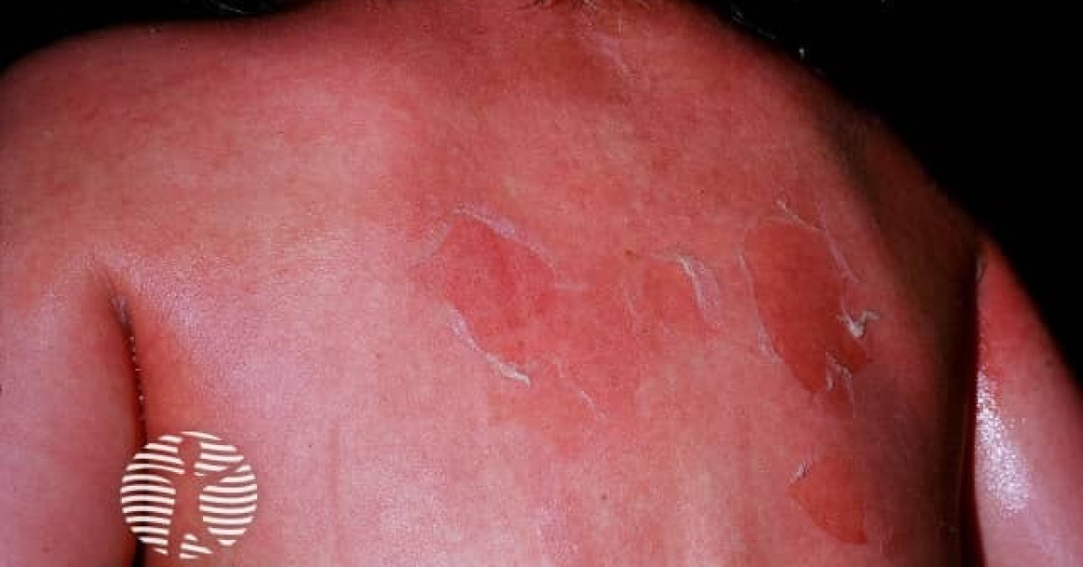 Staphylococcal Scalded Skin Syndrome Image