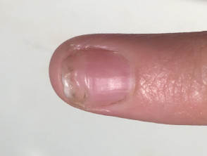 Nail recovery after trauma