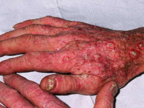 Sun damaged hands in renal transplant patient