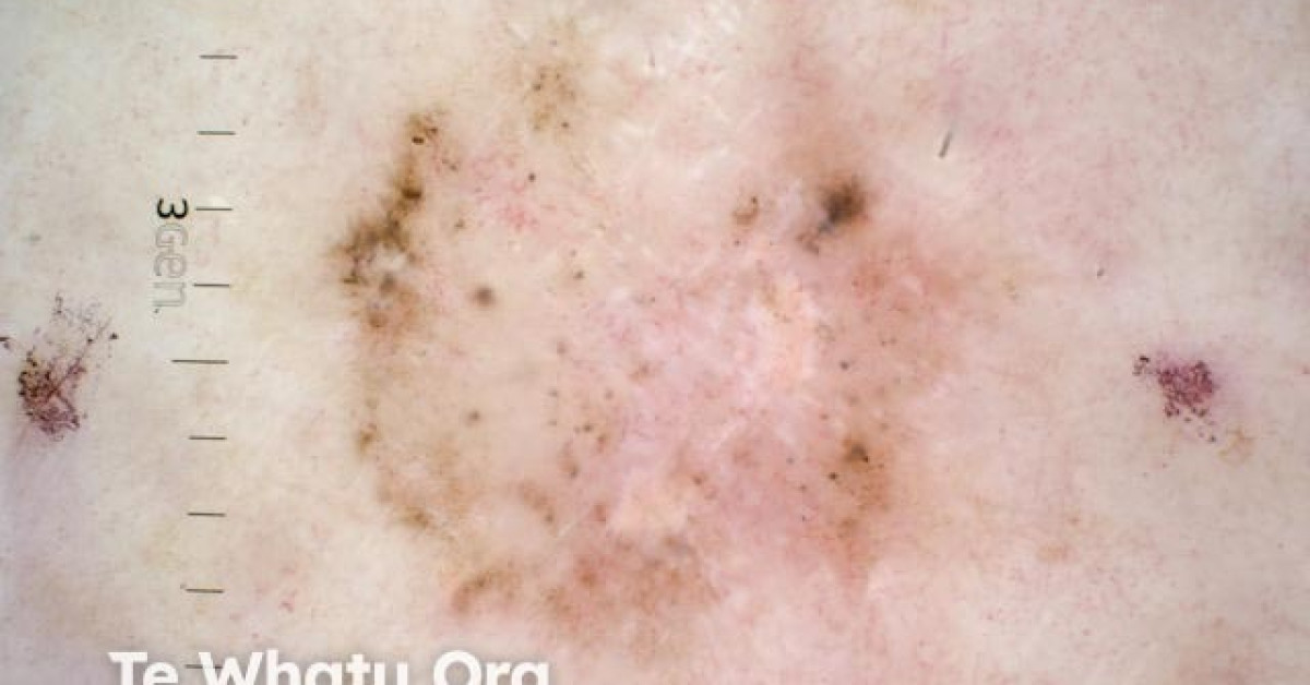 Superficial basal cell carcinoma polarised dermoscopy view image