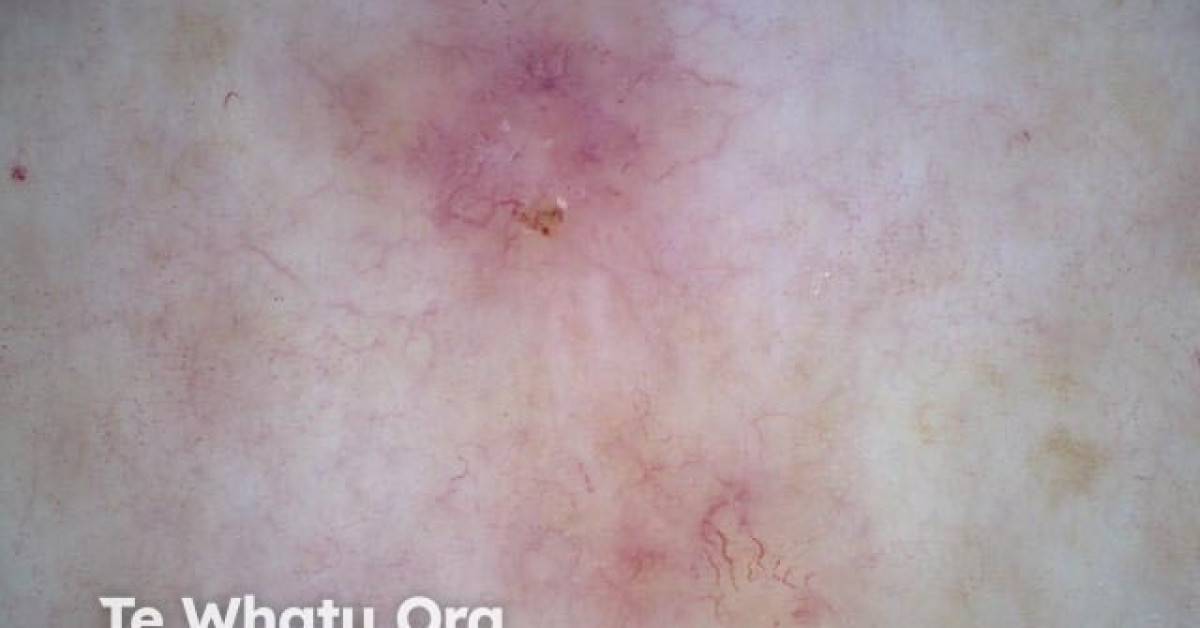 Superficial basal cell carcinoma nonpolarised dermoscopy