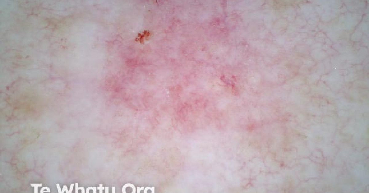 Superficial basal cell carcinoma nonpolarised dermoscopy