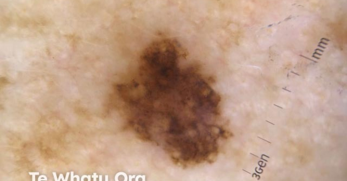 Dermoscopy of superficial spreading melanoma image