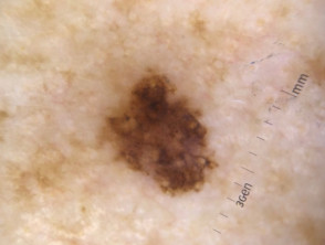 Dermoscopy of superficial spreading melanoma 