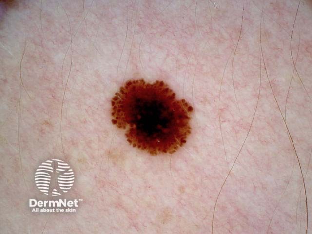 Superficial spreading melanoma, Breslow 0.4 mm, polarised dermoscopy view