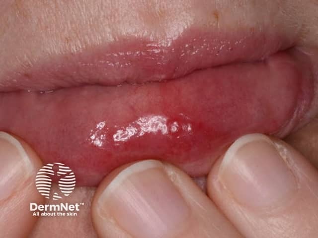 Sweet syndrome affecting lip