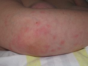 Sweet syndrome due to vemurafenib