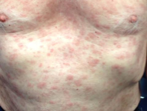 std skin rash on chest
