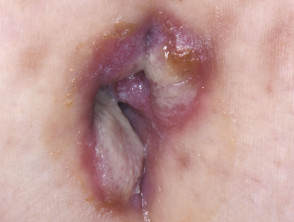 syphilis on thigh
