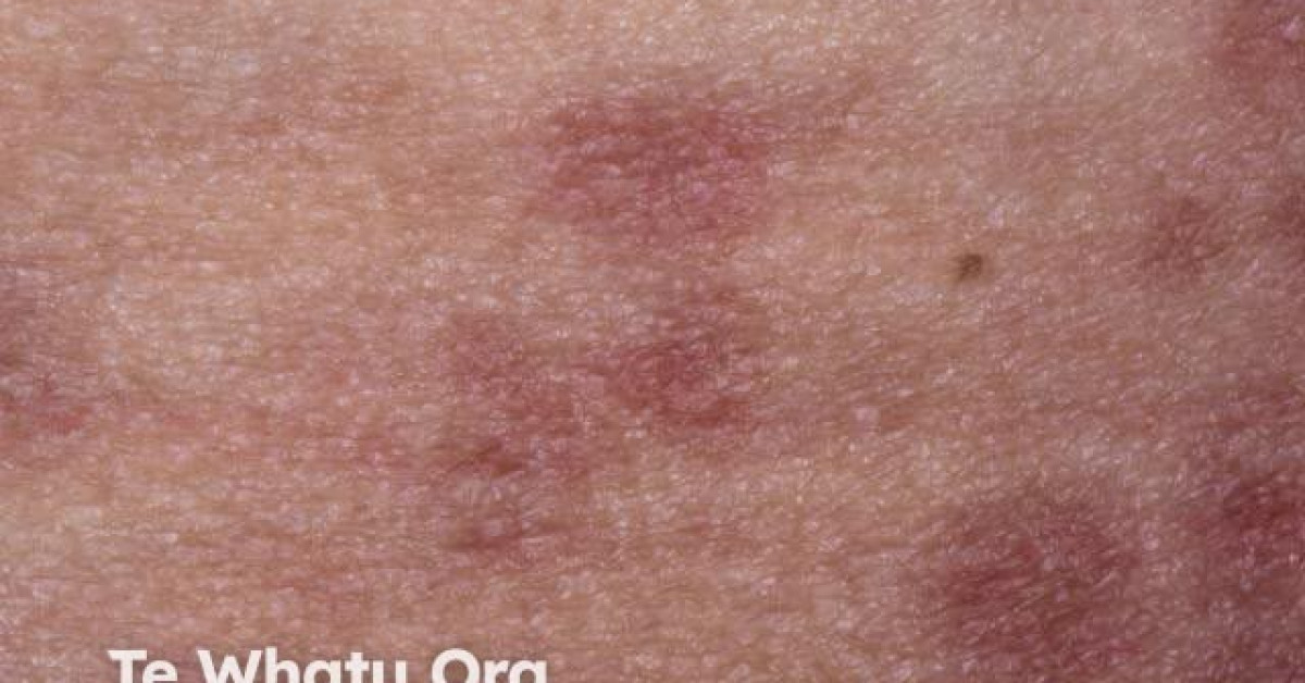 RASH image