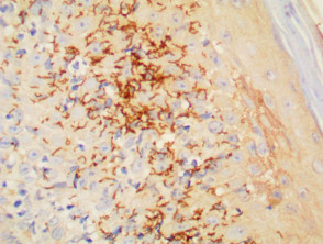 Syphilis pathology with organisms shown by Treponema pallidum immunohistochemistry stain  x400