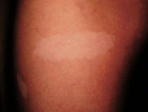 Ash leaf marks in tuberous sclerosis