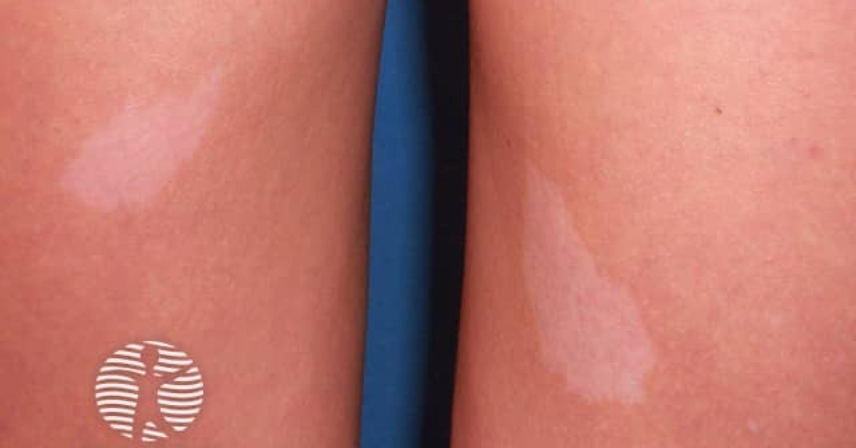 Ash Leaf Marks In Tuberous Sclerosis Image ash-leaf-spot-mycosphaerella-fraxinicola-schwein-house