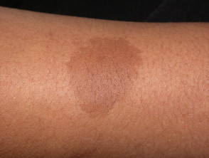 Cafe Au Lait Birthmarks: What They Are & Treatment Options