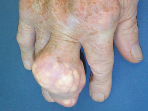 Icd 10 gouty arthritis