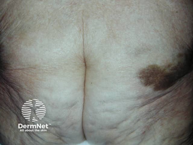 Pigmentation on the buttock due to iron after intramuscular injection for iron deficiency