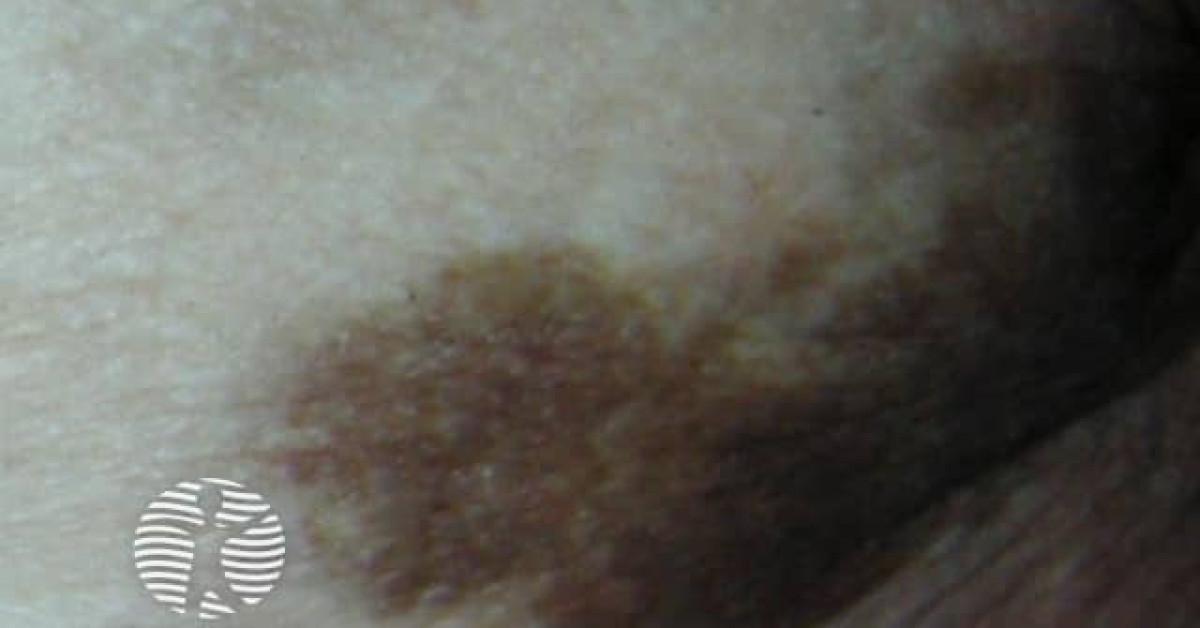 Infed Injection Stain Stain from iron injection image