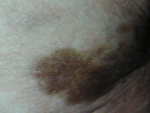 Stain from iron injection