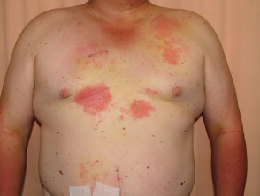 DermDx: Red Itchy Rash on Chest - Clinical Advisor