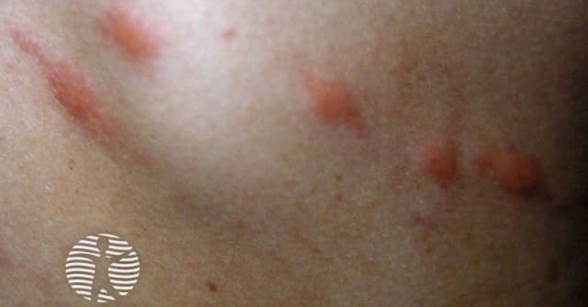 DermNet® - Insect Bites Image