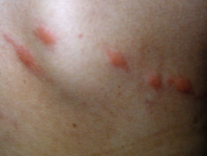 Differential diagnosis itchy skin | DermNet