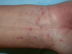 The Differential Diagnosis Of Itchy Skin Dermnet Nz