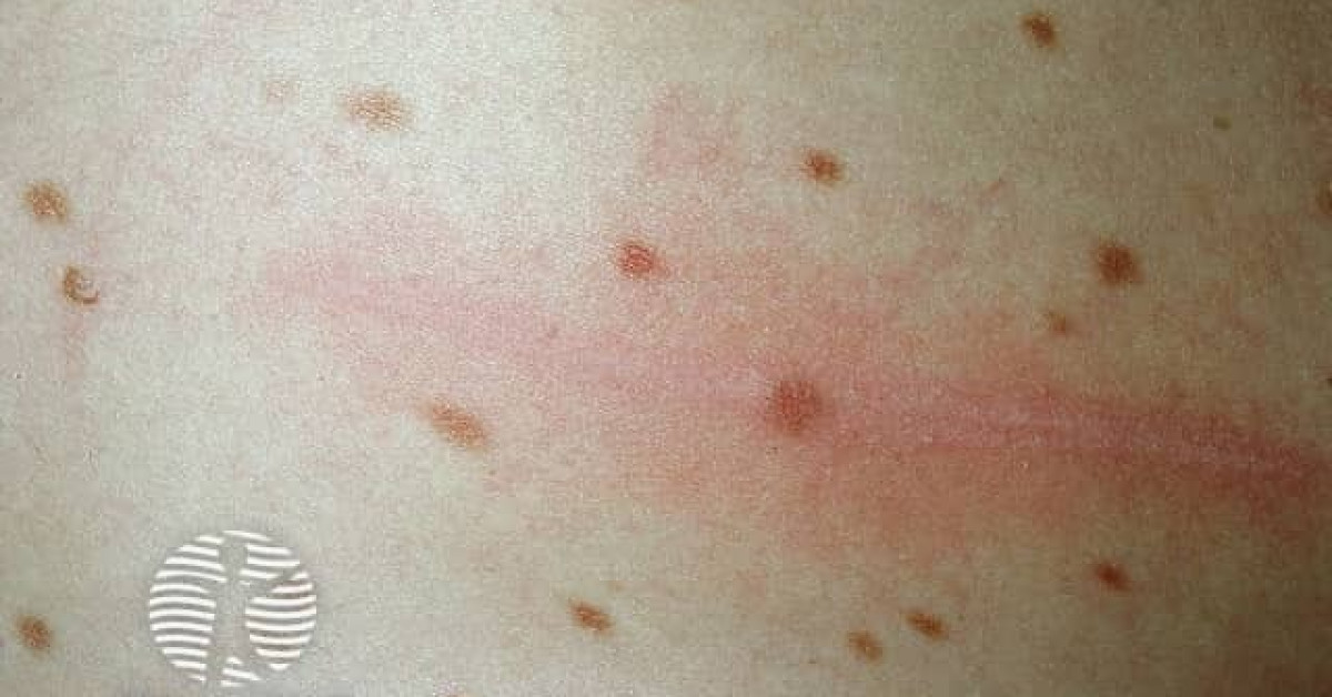 Maculopapular Mastocytosis Urticaria Pigmentosa Image