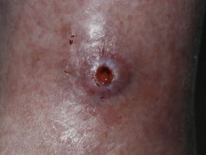 Morgellon disease