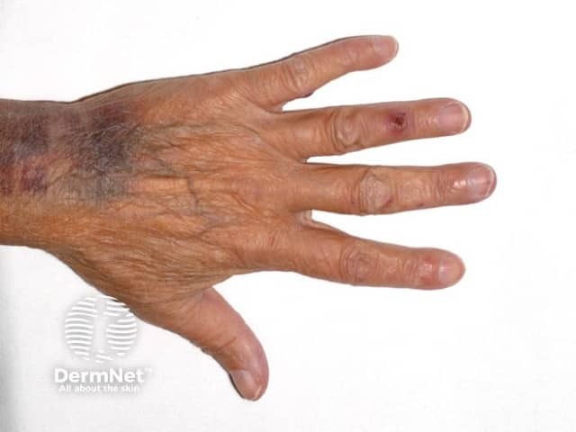 Osler node on ring finger as well as more subtle nodes seen on the little and middle finger