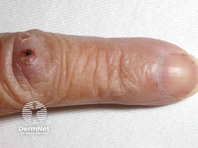 Osler nodes on index finger. Note also the tiny splinter haemorrhages on fingernail also seen in end