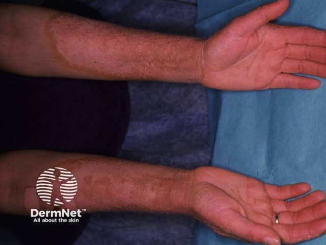 Pellagra dermatitis on forearms