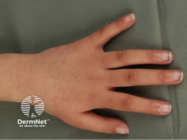 Telangiectasia on back of hand
