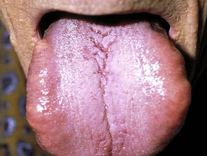 Macroglossia due to systemic amyloidosis