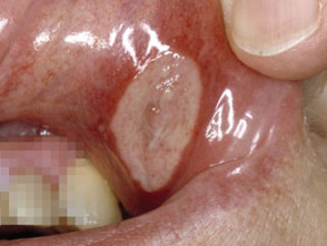 ulcer on floor of mouth