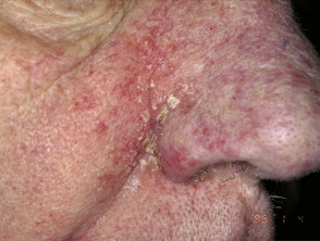 Seborrhoeic dermatitis
