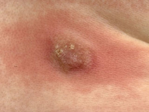 Mastocytoma after rubbing: Darier sign