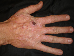 Squamous cell Carcinoma