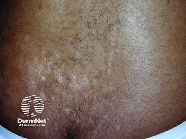 Shagreen patch in tuberous sclerosis
