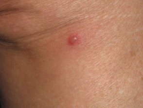 Skin rash due to bowel bypass syndrome