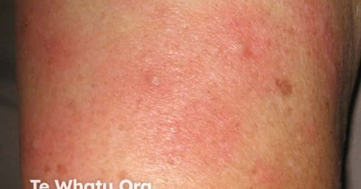 Skin rash due to bowel bypass syndrome image