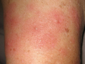 Skin rash due to bowel bypass syndrome
