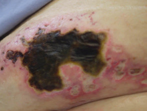 Calciphylaxis