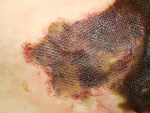 Calciphylaxis