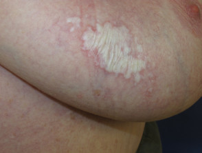 Itchy rash on breast?