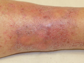 The Differential Diagnosis Of Itchy Skin Dermnet Nz