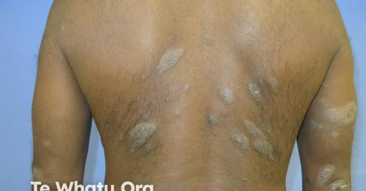 Discoid eczema image