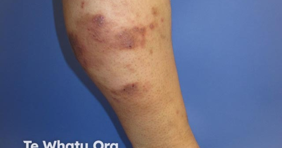 Discoid eczema image